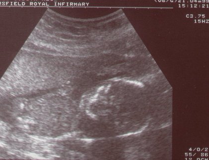 Katie's scan picture April 21st 1999.